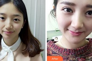 阜陽福田眼科醫(yī)院顧永昊整形價格表附切開雙眼皮案例展示