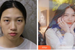 阜陽福田眼科醫(yī)院王福田整形價格表附切開雙眼皮案例展示