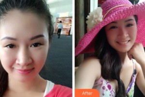 阜陽中西醫(yī)結(jié)合眼耳鼻喉科醫(yī)院汝子杰整形價格表附切開雙眼皮案例展示