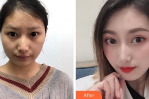 阜陽市第七人民醫(yī)院眼科高明煜整形價格表附開內(nèi)眼角案例展示