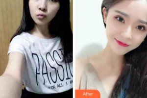 阜陽市第五人民醫(yī)院整形美容科袁道毅整形價格表附眼部綜合案例展示