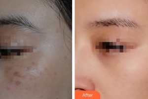 宿州陽光醫(yī)療美容醫(yī)院王雙雙整形價格表附激光祛痣案例展示