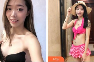 宿州康麗醫(yī)療美容門(mén)診部胡朝暉整形價(jià)格表附自體脂肪隆胸案例展示