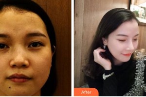 宿州陽(yáng)光醫(yī)療美容醫(yī)院王武整形價(jià)格表附隆鼻案例展示