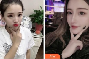 宿州漢密爾頓醫(yī)學(xué)美容醫(yī)院鐘貴紅整形價(jià)格表附鼻部綜合案例展示