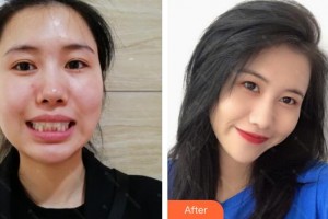 宿州愛(ài)牙口腔醫(yī)院張偉彬整形價(jià)格表附牙齒隱形矯正案例展示