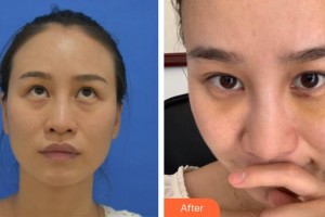 宿州市第一人民醫(yī)院眼科曹天龍整形價(jià)格表附祛眼袋案例展示