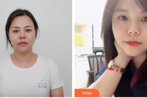 宿州京美醫(yī)療美容醫(yī)院年京京整形價(jià)格表附雙眼皮案例展示