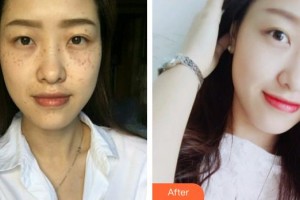 巢湖麗膚中西醫(yī)結(jié)合門(mén)診部醫(yī)療美容科程友軍整形價(jià)格表附祛斑案例展示