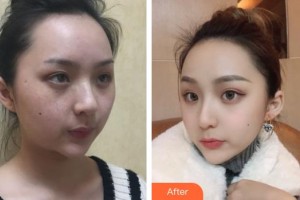 六安市人民醫(yī)院醫(yī)學(xué)美容中心余培銀整形價(jià)格表附祛斑案例展示