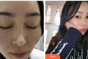 六安伊而美醫(yī)療整形美容醫(yī)院陳敬武整形價(jià)格表附激光祛斑案例展示