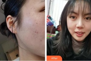 六安伊而美醫(yī)療整形美容醫(yī)院黃莉整形價(jià)格表附祛斑案例展示