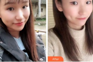 六安皖美口腔門(mén)診部馬曉春整形價(jià)格表附牙綜合案例展示