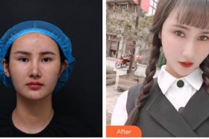 六安瑞視眼科醫(yī)院陳寶海整形價格表附眼部修復(fù)案例展示