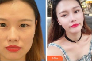 六安瑞視眼科醫(yī)院汪樂田整形價格表附雙眼皮案例展示