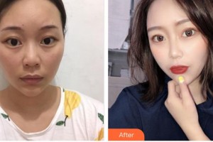 亳州市人民醫(yī)院整形外科薛仰杰整形價格表附眼部手術(shù)案例展示