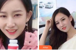 亳州嚴秀口腔診所嚴秀整形價格表附牙齒隱形矯正案例展示