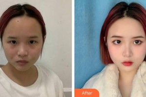 池州伊尚美醫(yī)療美容門診部孫開全整形價格表附激光美膚祛斑案例展示