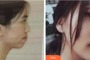 池州伊尚美醫(yī)療美容門診部陸黛咪整形價格表附金屬托槽矯正案例展示