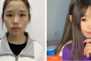 池州佳美皮膚美容醫(yī)院李光農(nóng)整形價格表附激光美膚祛斑案例展示