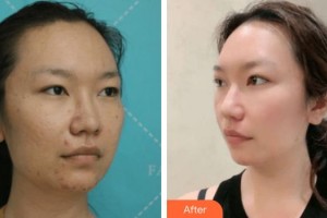 池州愛爾眼科醫(yī)院汪勝利整形價格表附切開雙眼皮案例展示