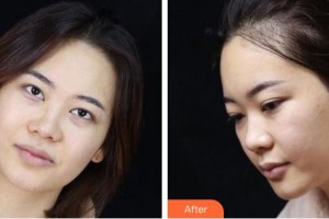 池州市人民醫(yī)院眼科姚有根整形價格表附眼鼻部手術(shù)案例展示