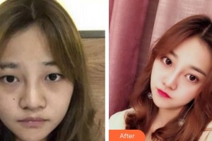 池州愛爾眼科醫(yī)院童曉陸整形價格表附切開雙眼皮案例展示