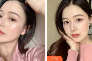 池州市人民醫(yī)院眼科汪鴻整形價格表附眼部綜合案例展示