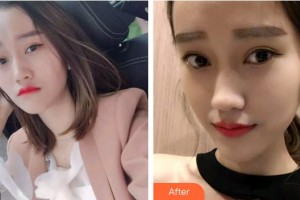 池州博雅口腔門診部汪琦霞整形價格表附牙齒隱形矯正案例展示