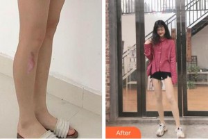 宣城人民醫(yī)院燒傷整形科章社民整形價格表附激光祛疤案例展示