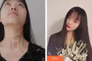 宣城人民醫(yī)院燒傷整形科劉登河整形價格表附燙傷疤痕修復(fù)案例展示