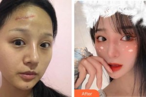 宣城中心醫(yī)院燒傷整形科金瑞整形價格表附激光祛疤案例展示