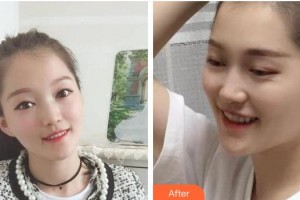 宣城為民口腔門診部呂敏整形價格表附金屬托槽矯正案例展示