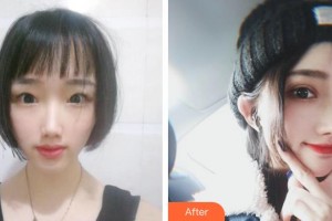 宣城康視五官科醫(yī)院眼科許剛整形價(jià)格表附切開雙眼皮案例展示