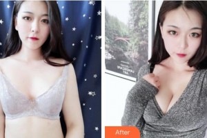 浙江綠城醫(yī)院整形美容中心徐堅方整形價格表附隆胸案例展示