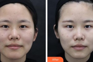 浙江綠城醫(yī)院整形美容中心金亦多整形價格表附激光祛斑案例展示