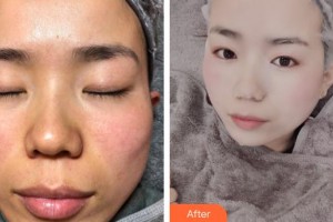 浙江大學(xué)醫(yī)學(xué)院附屬第二醫(yī)院整形科陶志平整形價格表附祛斑案例展示