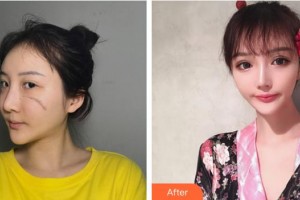 浙江大學(xué)醫(yī)學(xué)院附屬第二醫(yī)院整形科邵哲人整形價格表附激光祛疤案例展示