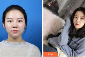 浙江大學(xué)醫(yī)學(xué)院附屬第二醫(yī)院整形科余建新整形價格表附鼻部綜合案例展示