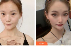 浙江省中醫(yī)院整形美容中心余土根整形價格表附微創(chuàng)疤痕修復(fù)案例展示