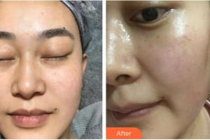 浙江省中醫(yī)院整形美容中心王雅飛整形價格表附光子嫩膚案例展示