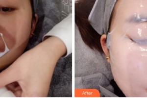 浙江省中醫(yī)院整形美容中心曹毅整形價格表附光子嫩膚案例展示