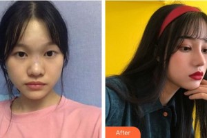 浙江省人民醫(yī)院整形外科石杭燕整形價格表附肋軟骨隆鼻案例展示