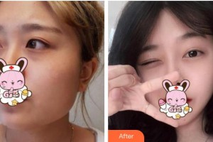 浙江省人民醫(yī)院整形外科朱保整形價格表附面部整形案例展示