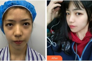 浙江省人民醫(yī)院整形外科吳華整形價格表附埋線提升案例展示