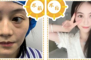 浙江省人民醫(yī)院整形外科冀宇整形價格表附埋線提升案例展示