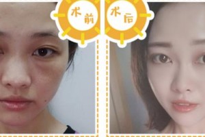 浙江綠城醫(yī)院整形美容中心張曉清整形價格表附埋線提升案例展示