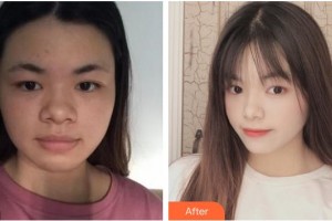 浙江綠城醫(yī)院整形美容中心趙峻賢整形價格表附埋線提升案例展示