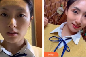 浙江衢化醫(yī)院激光整形美容中心陳玲玲整形價格表附埋線提升案例展示