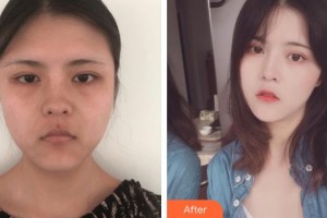 浙江衢化醫(yī)院激光整形美容中心康樂整形價格表附埋線提升案例展示